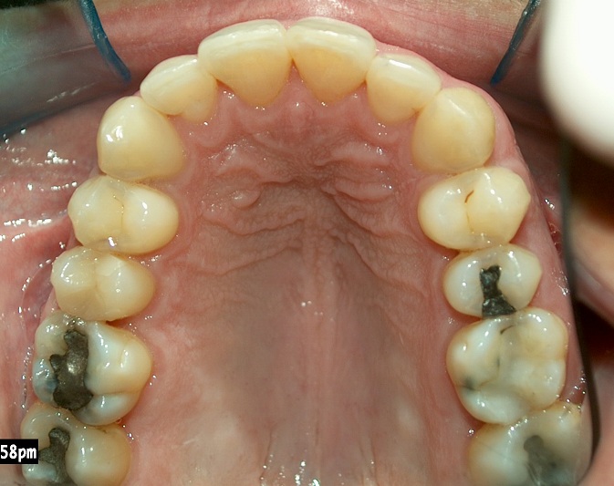 After picture of treatment