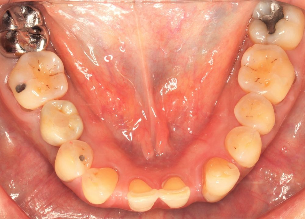After picture of treatment